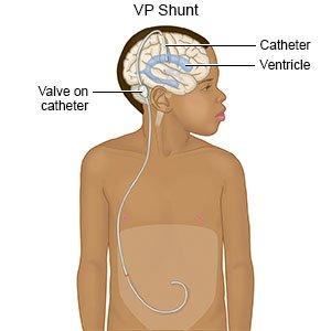 /Ventriculoperitoleal Shunt - V.P Shunt